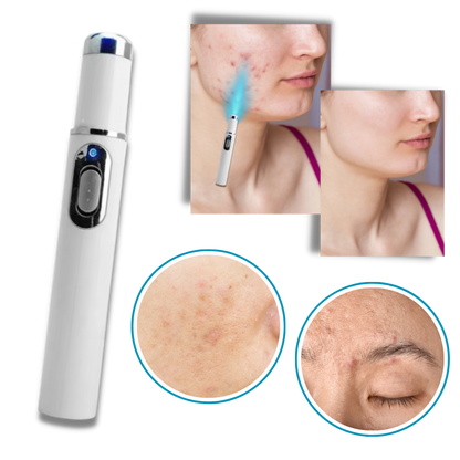 Laser do Skóry Przenośne Pióro do Usuwania Blizn i Przebarwień